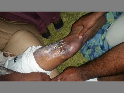 Wounded... Some of the burns on the victim's body. The attack has left the community shocked.