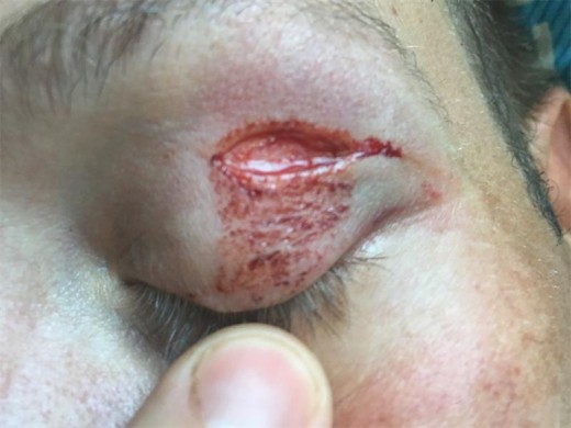 The laceration Dr Jacques Visser sustained above his eye when he rode through the footpath exit.