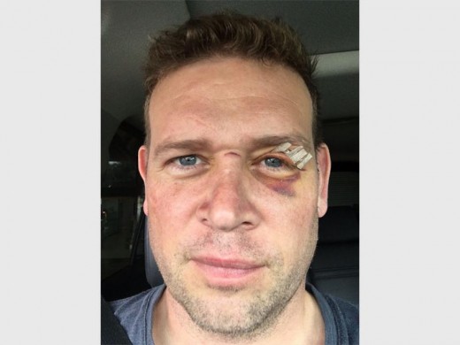 Dr Jacques Visser sustained lacerations to the eye, as well as bruising, from an unmarked wire.